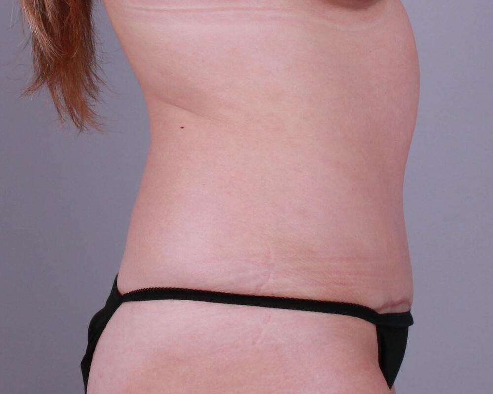 Tummy Tuck Before & After Image