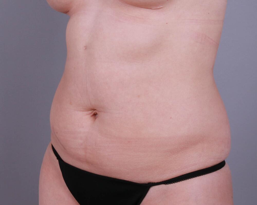 Tummy Tuck Before & After Image