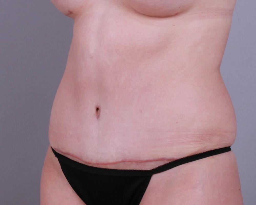 Tummy Tuck Before & After Image