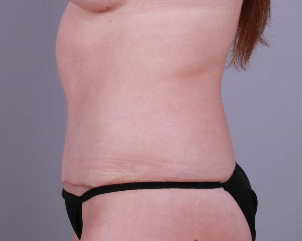 Tummy Tuck Before & After Image