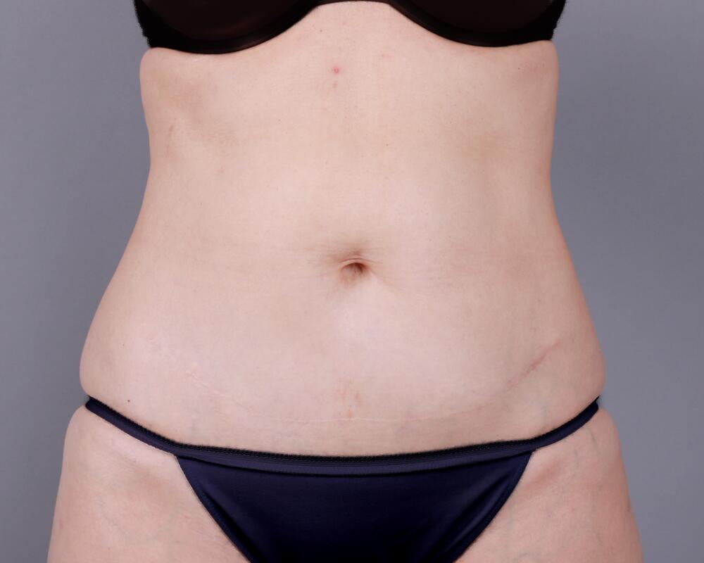 Tummy Tuck Before & After Image