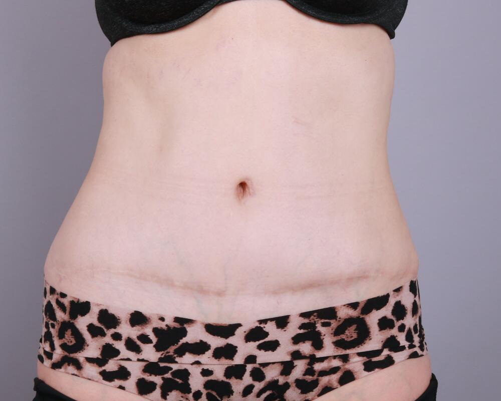 Tummy Tuck Before & After Image