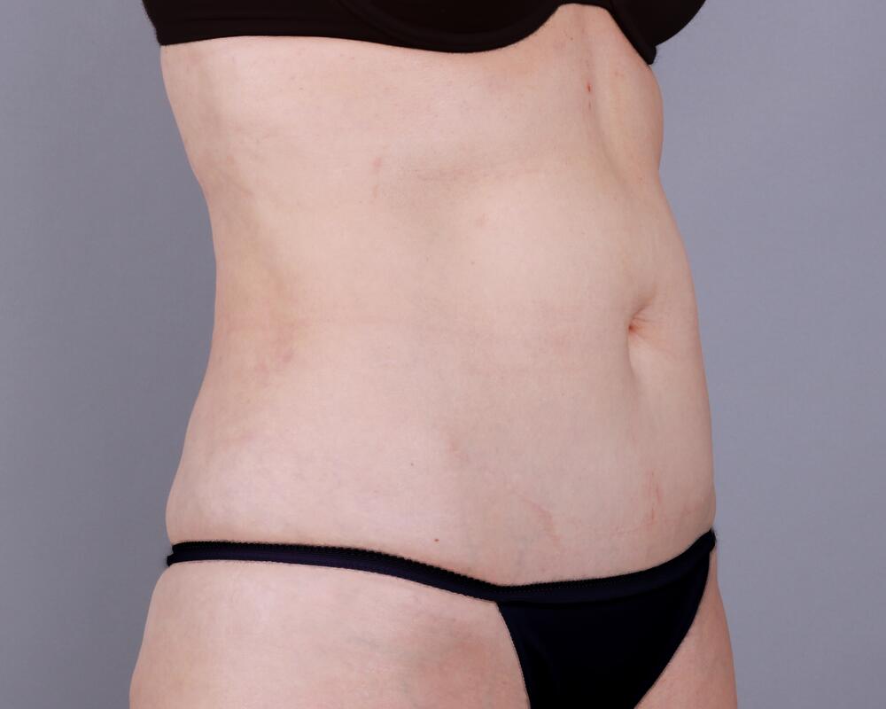 Tummy Tuck Before & After Image