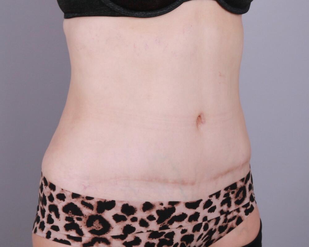 Tummy Tuck Before & After Image