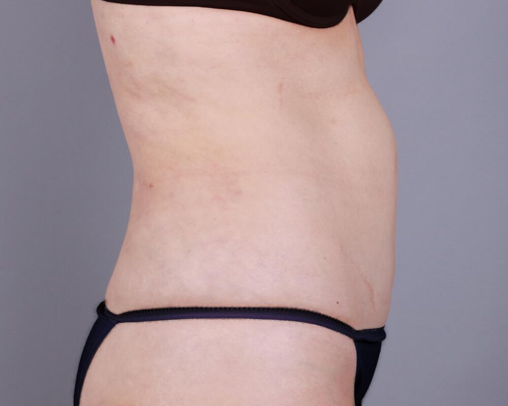 Tummy Tuck Before & After Image