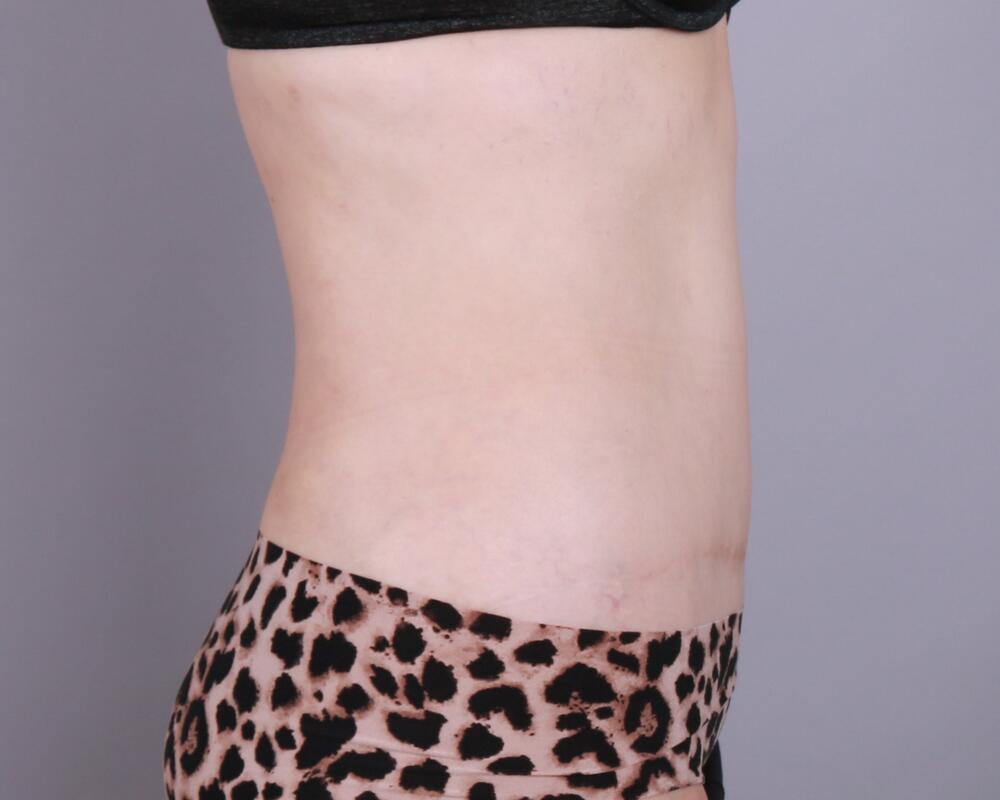 Tummy Tuck Before & After Image