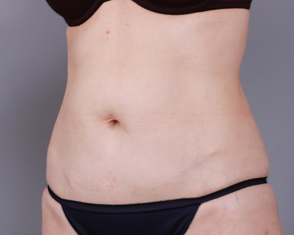 Tummy Tuck Before & After Image