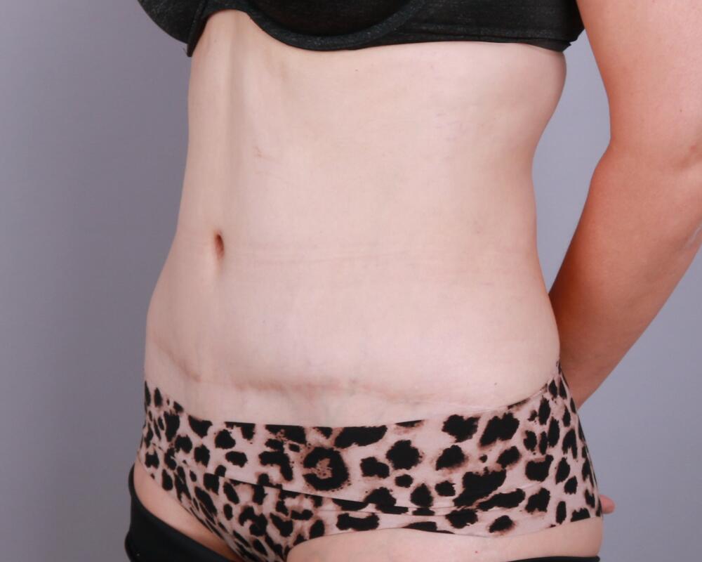 Tummy Tuck Before & After Image