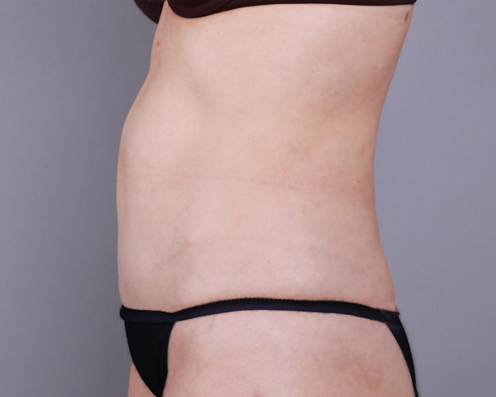 Tummy Tuck Before & After Image