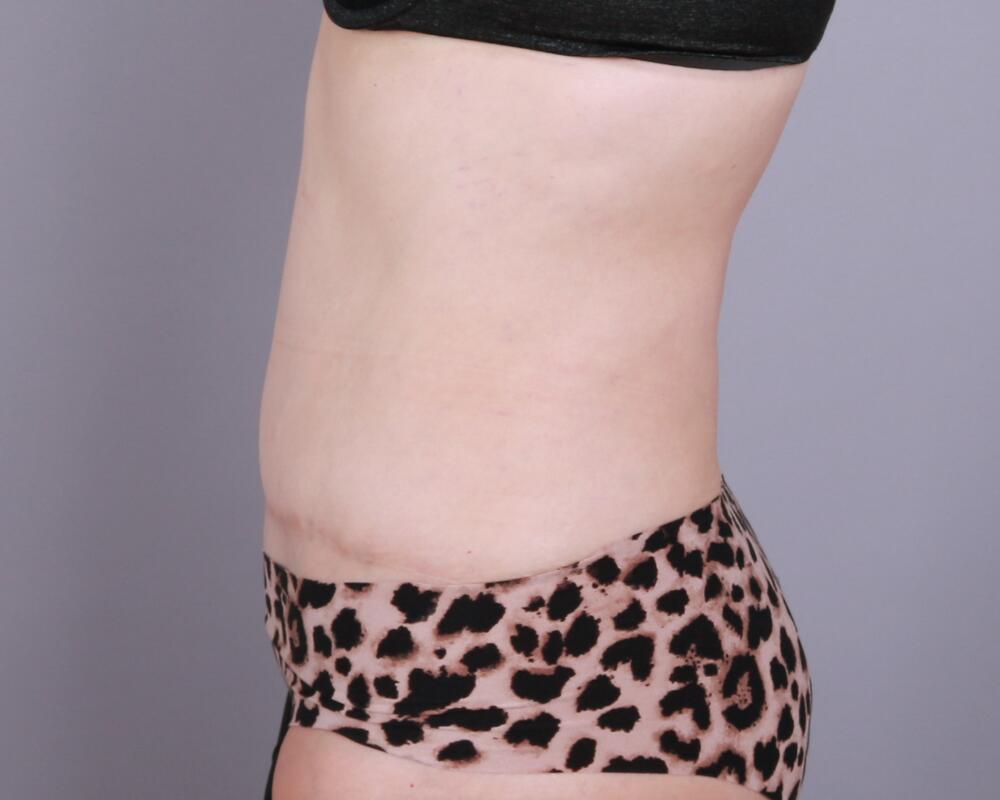 Tummy Tuck Before & After Image