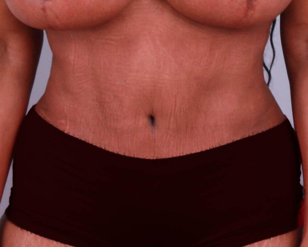 Tummy Tuck Before & After Image