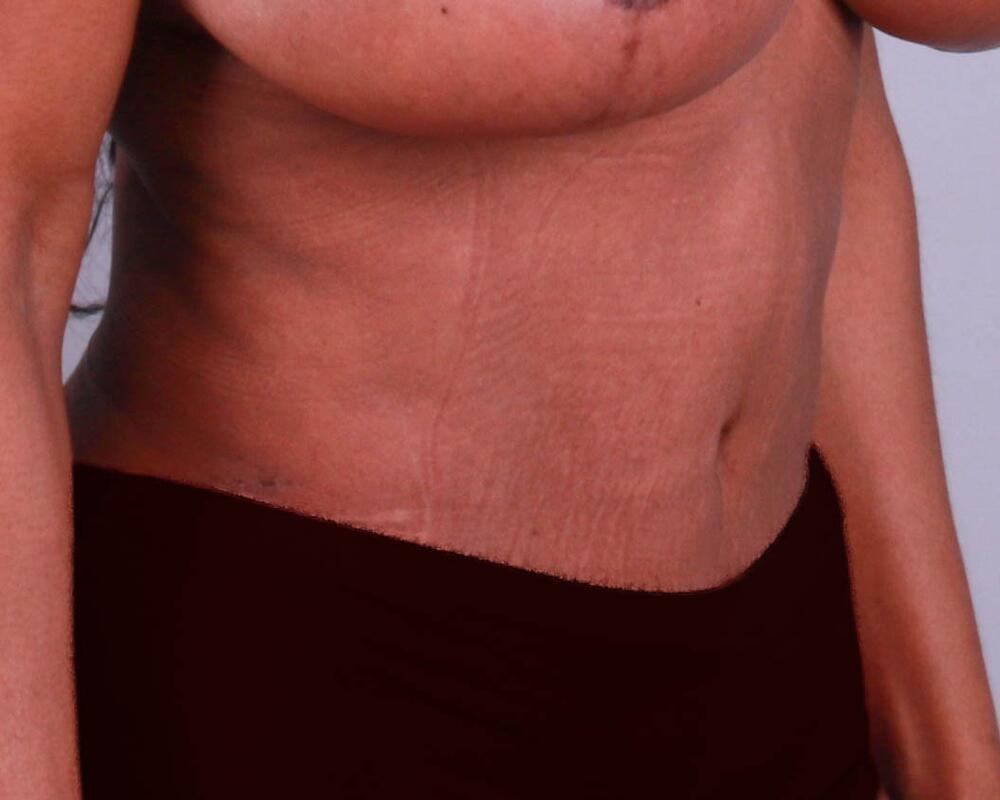 Tummy Tuck Before & After Image