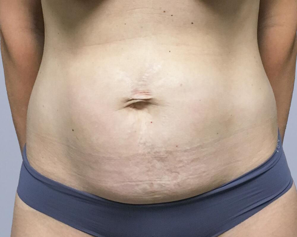 Tummy Tuck Before & After Image