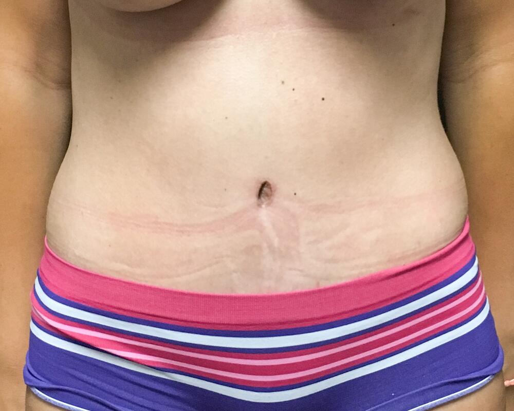 Tummy Tuck Before & After Image