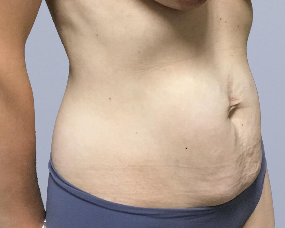 Tummy Tuck Before & After Image