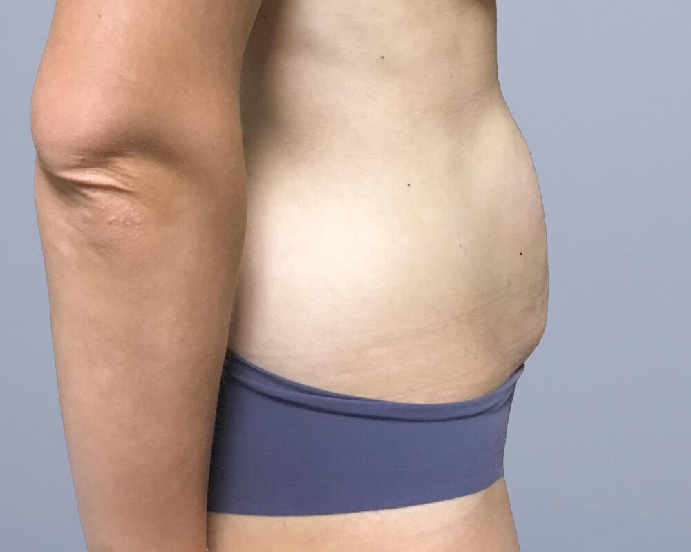 Tummy Tuck Before & After Image