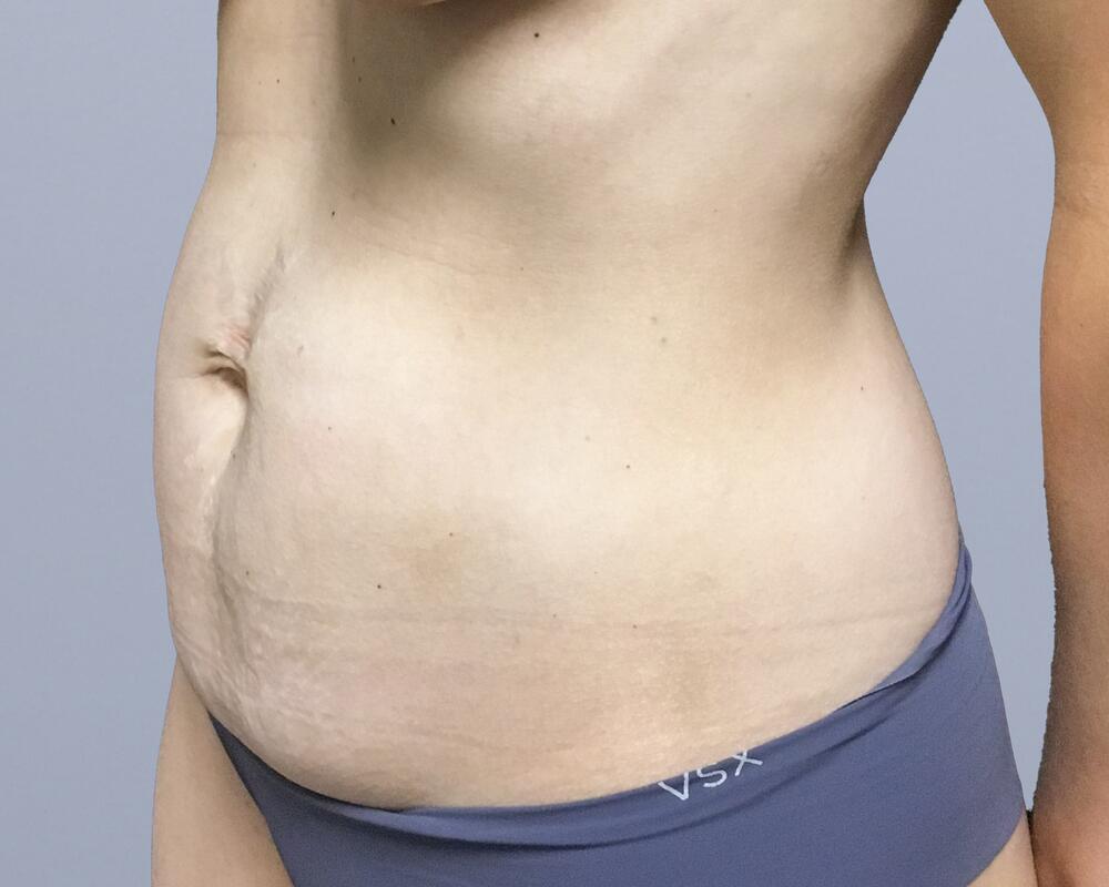 Tummy Tuck Before & After Image