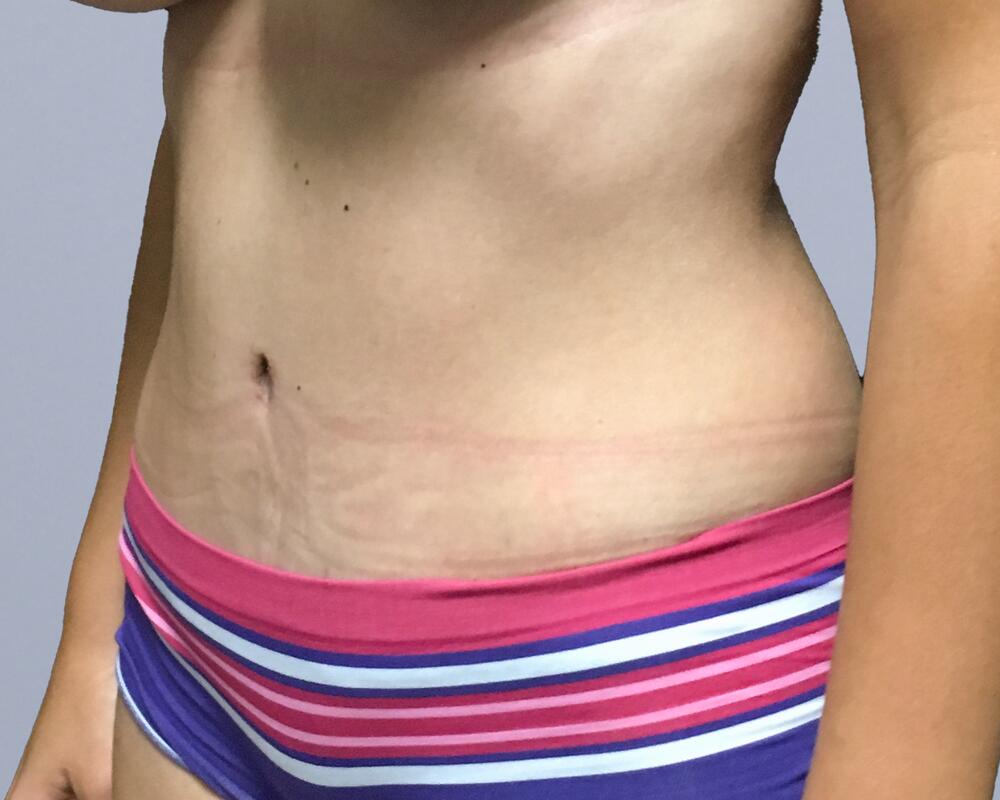 Tummy Tuck Before & After Image