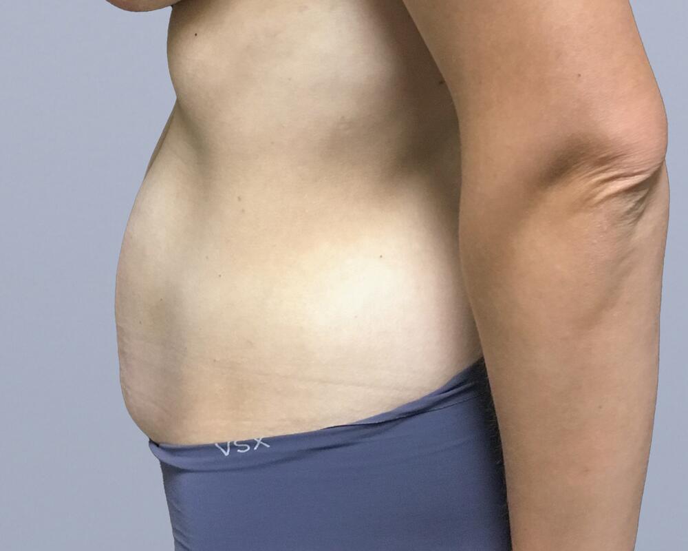 Tummy Tuck Before & After Image