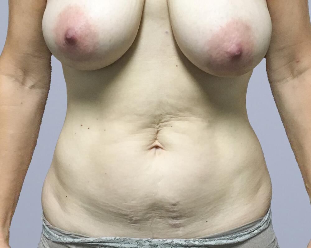 Tummy Tuck Before & After Image