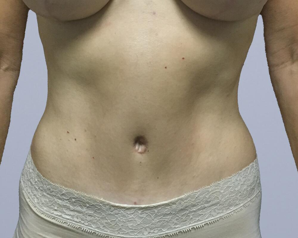 Tummy Tuck Before & After Image