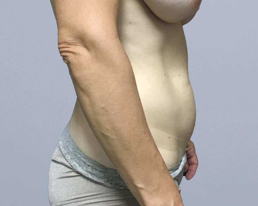 Tummy Tuck Before & After Image