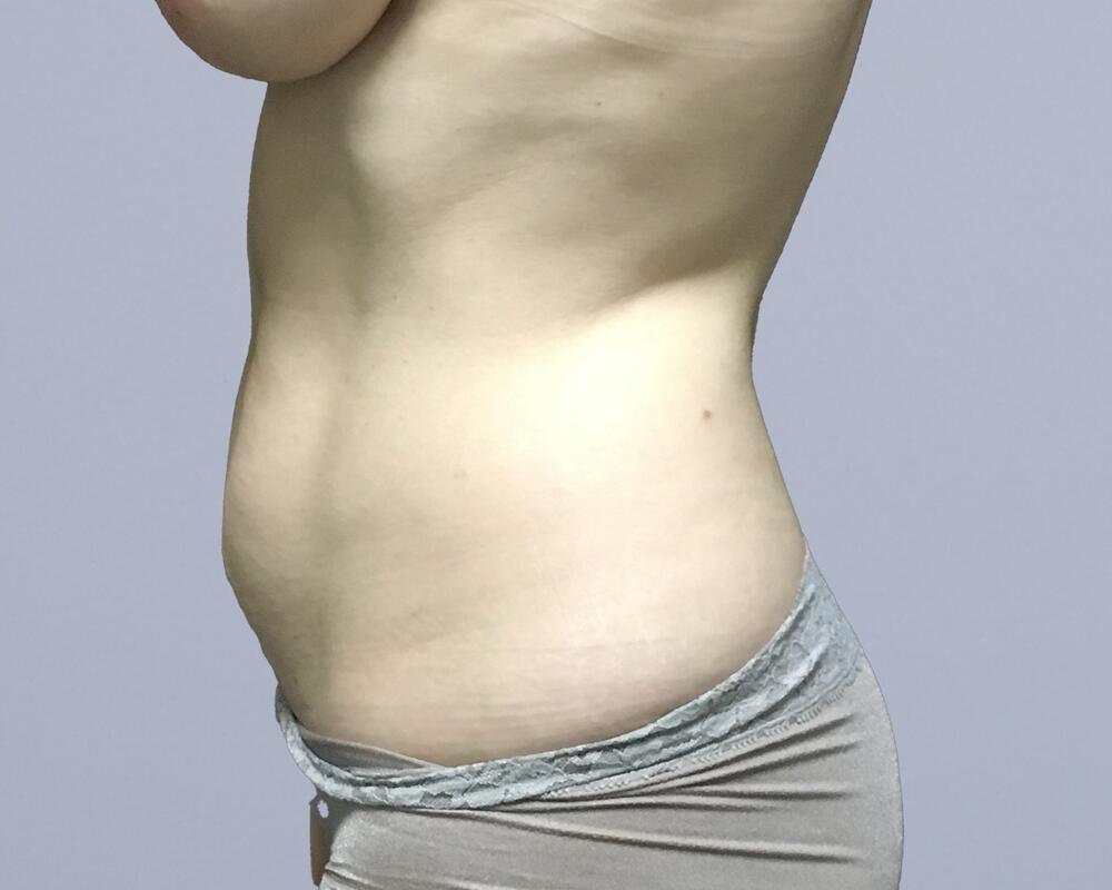 Tummy Tuck Before & After Image