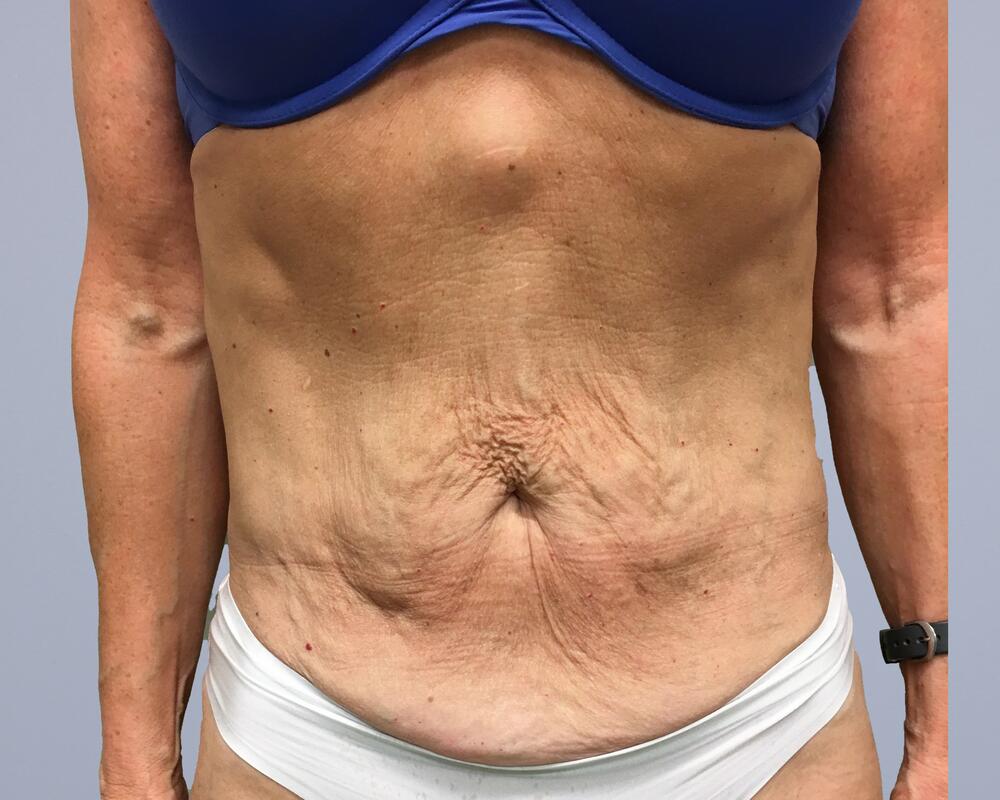 Tummy Tuck Before & After Image