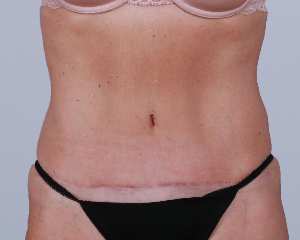 Tummy Tuck Before & After Image