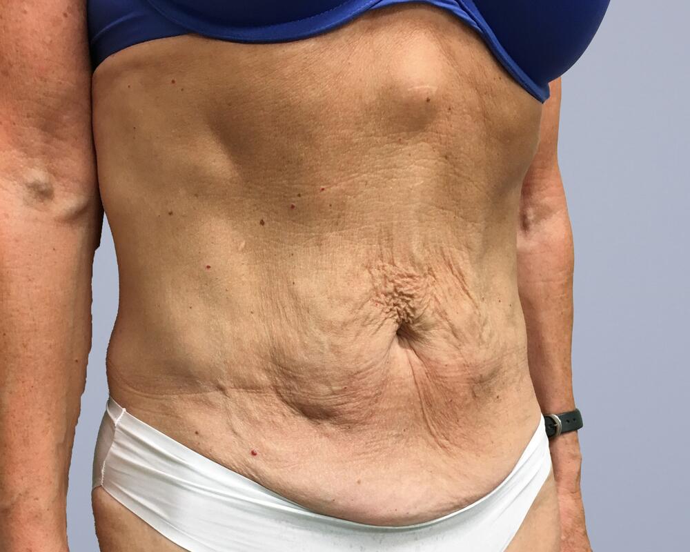 Tummy Tuck Before & After Image