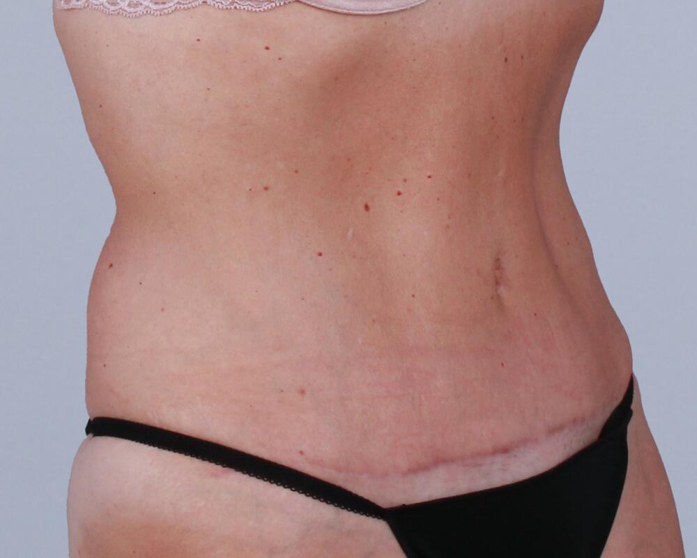 Tummy Tuck Before & After Image