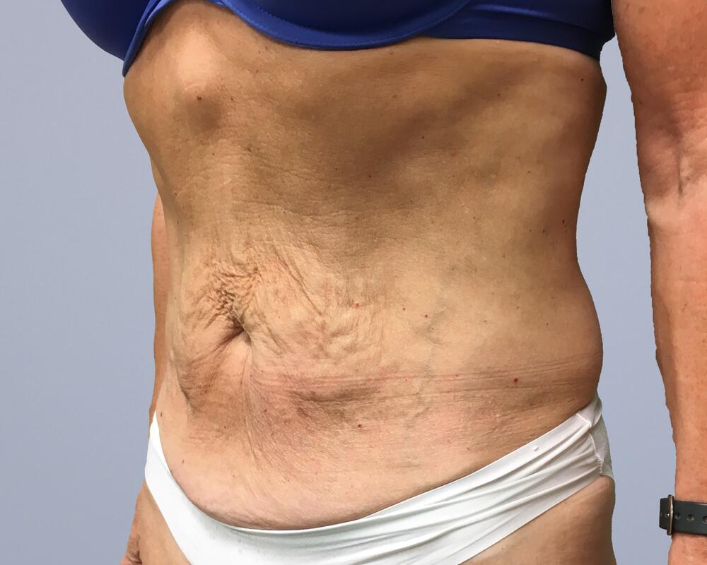 Tummy Tuck Before & After Image