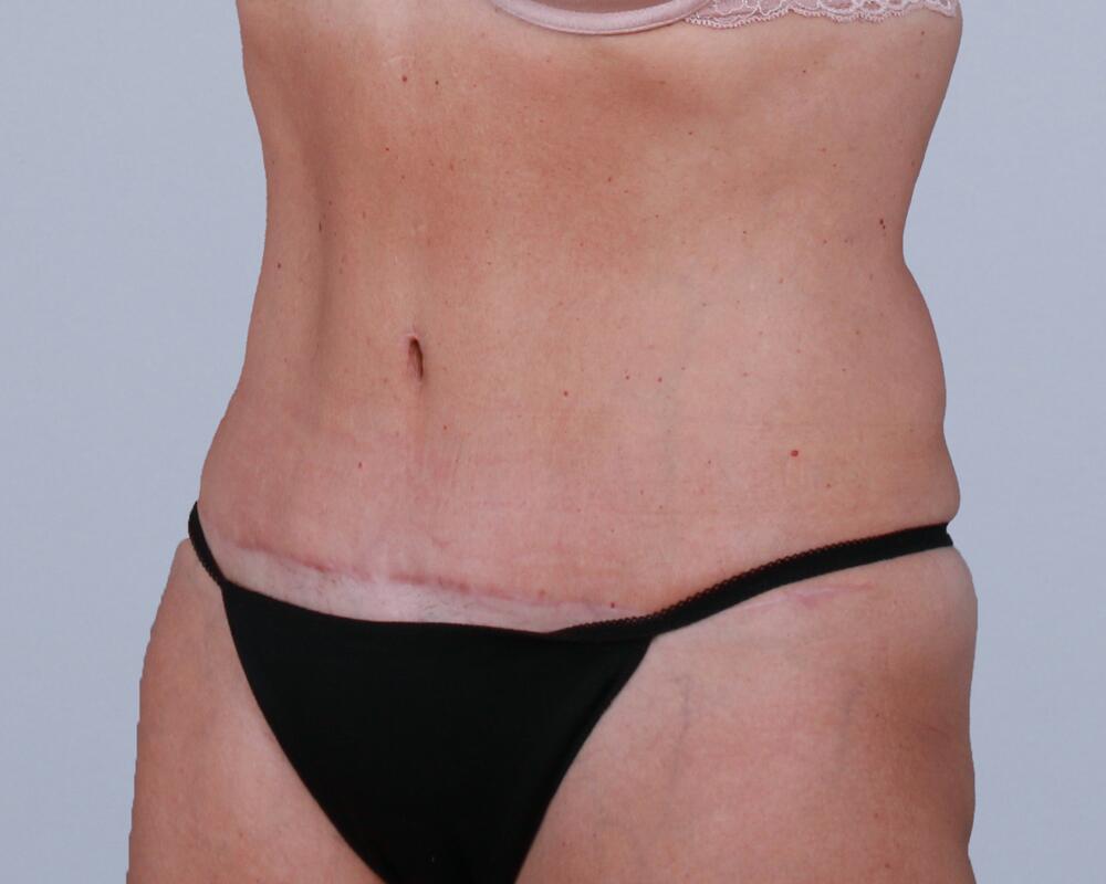 Tummy Tuck Before & After Image