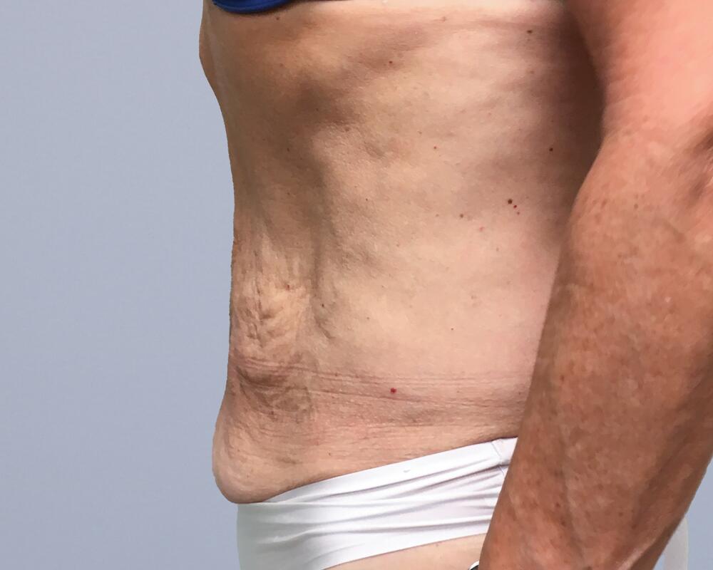 Tummy Tuck Before & After Image