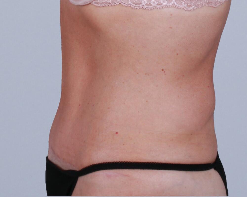 Tummy Tuck Before & After Image