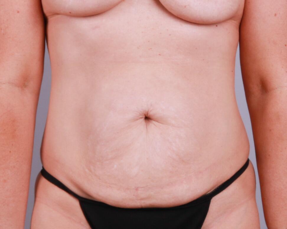 Tummy Tuck Before & After Image