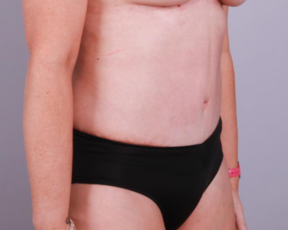 Tummy Tuck Before & After Image