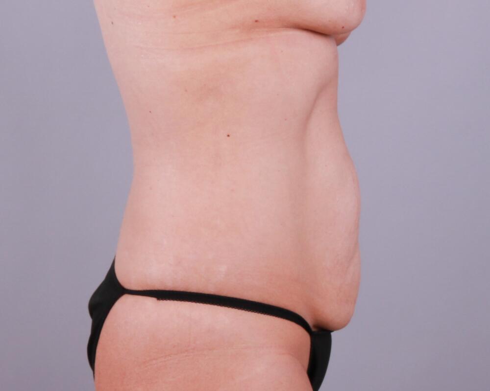 Tummy Tuck Before & After Image