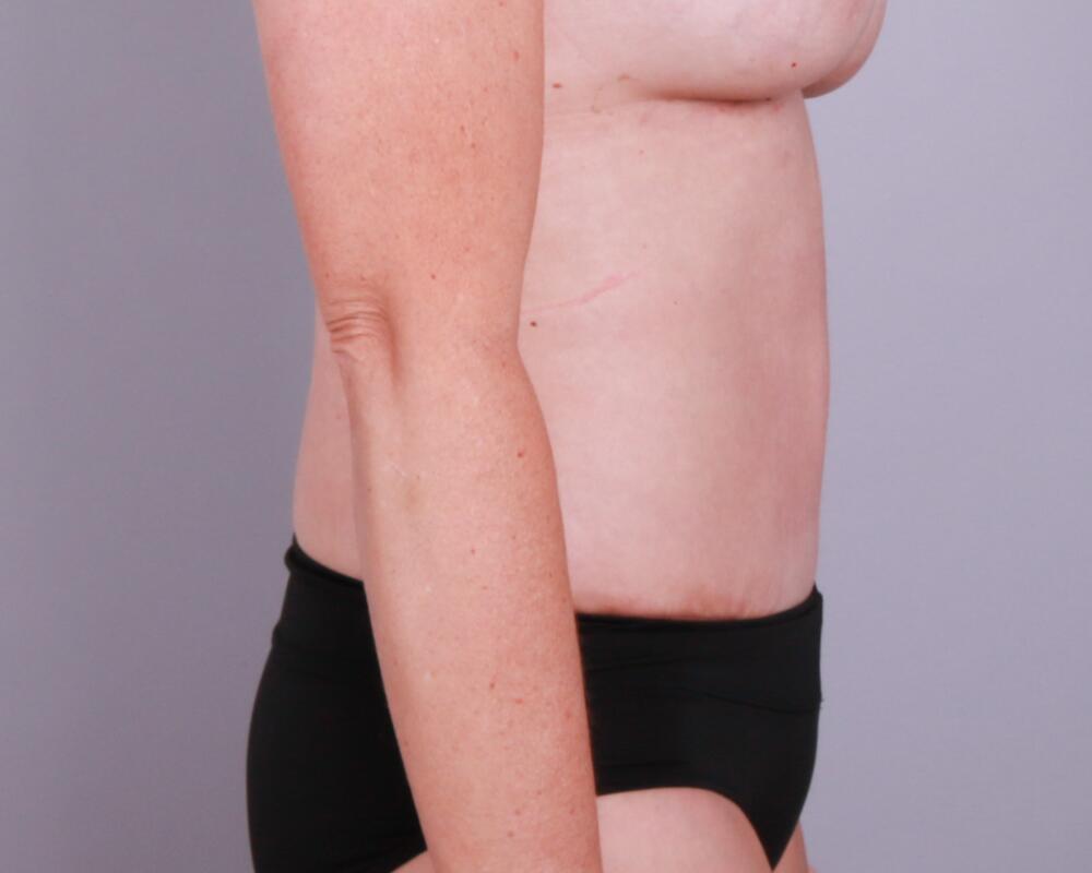 Tummy Tuck Before & After Image