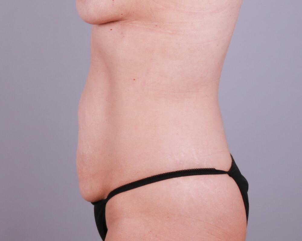 Tummy Tuck Before & After Image