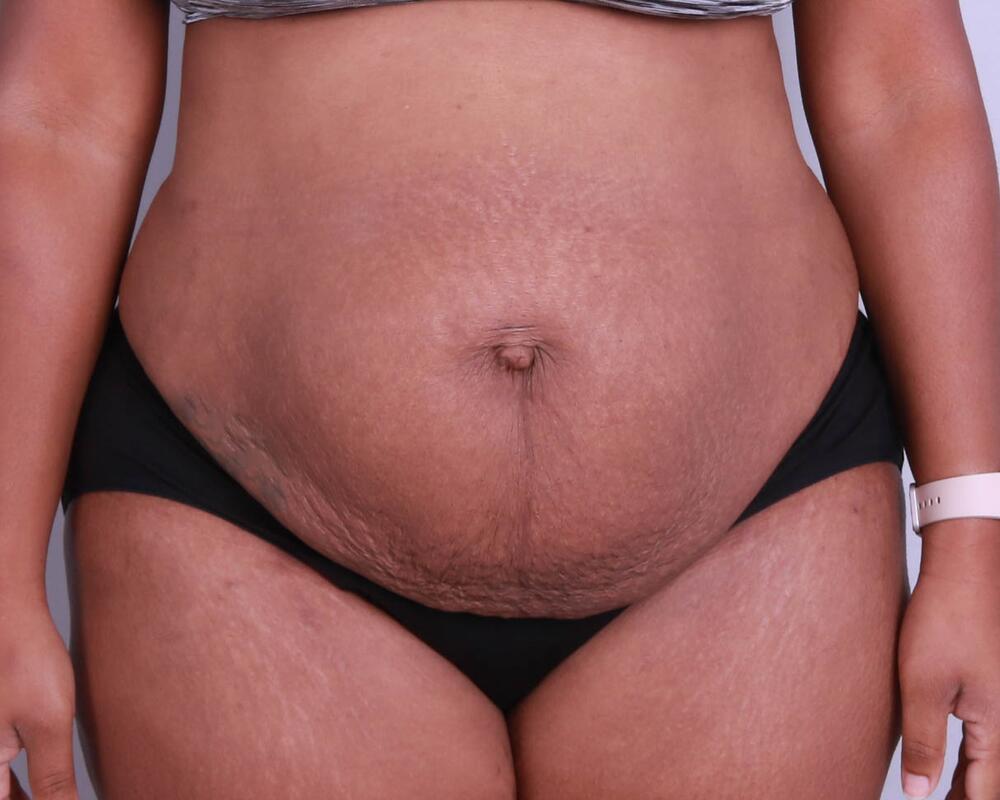 Tummy Tuck Before & After Image