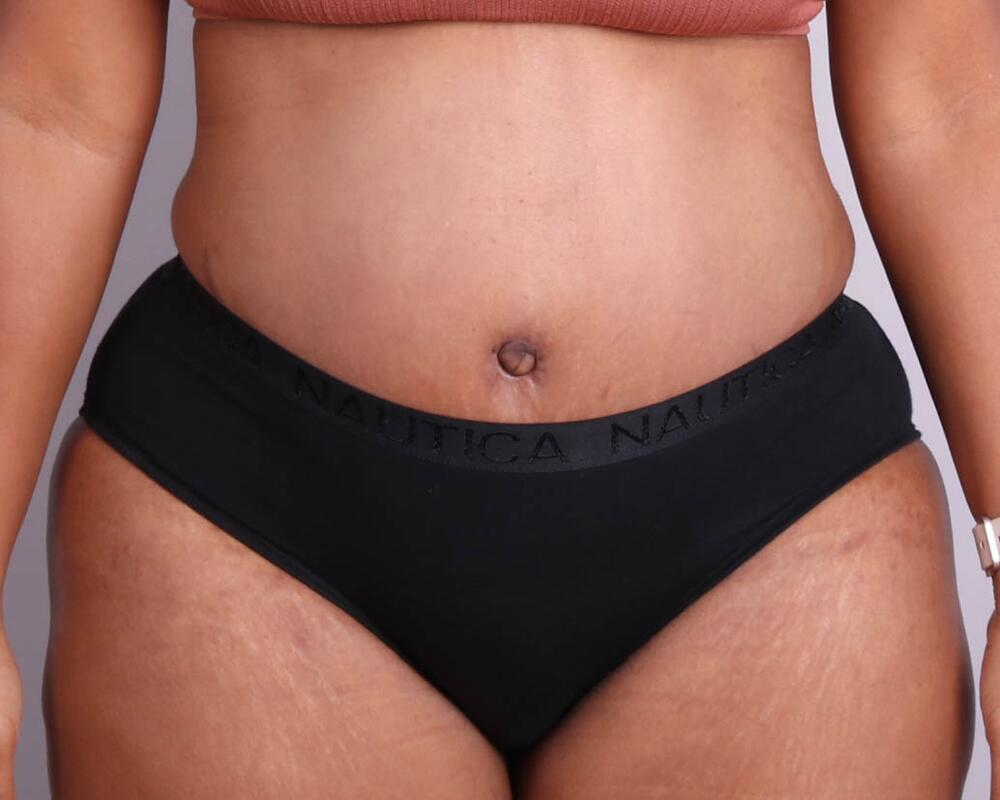 Tummy Tuck Before & After Image