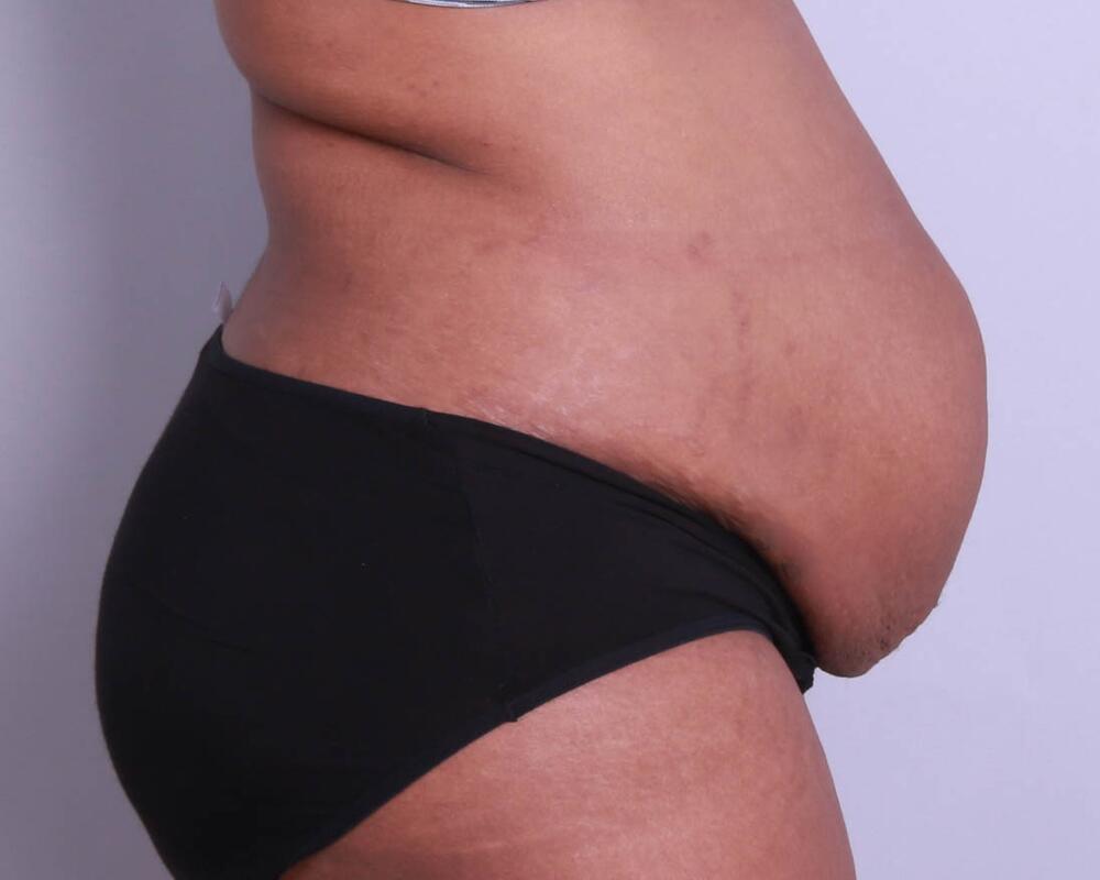 Tummy Tuck Before & After Image