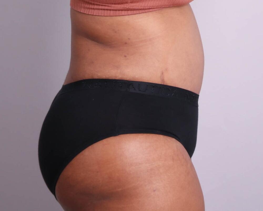 Tummy Tuck Before & After Image