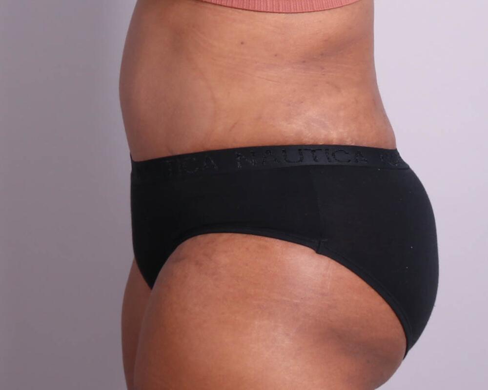 Tummy Tuck Before & After Image