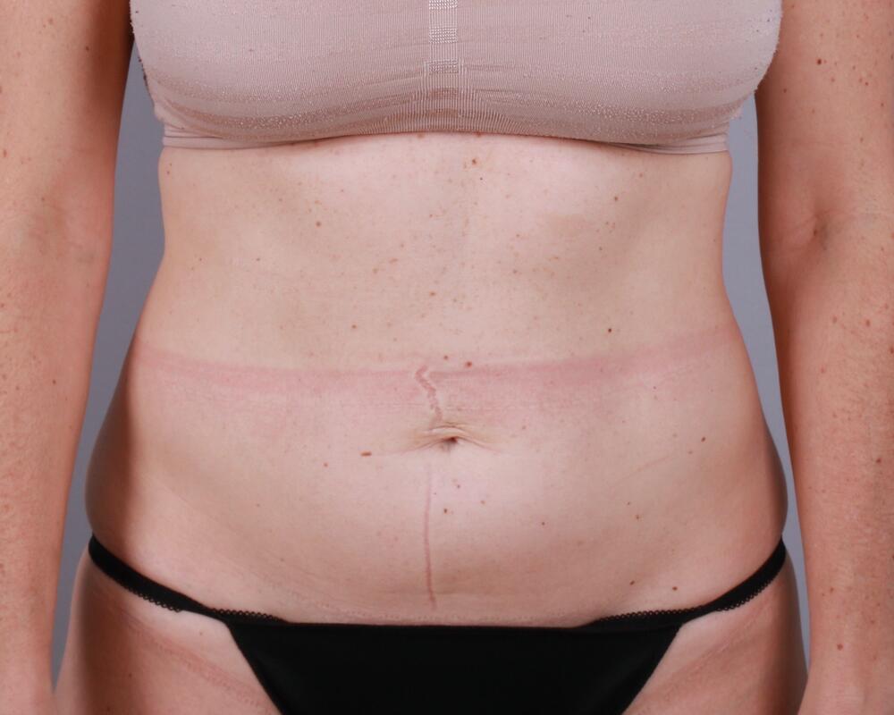 Tummy Tuck Before & After Image