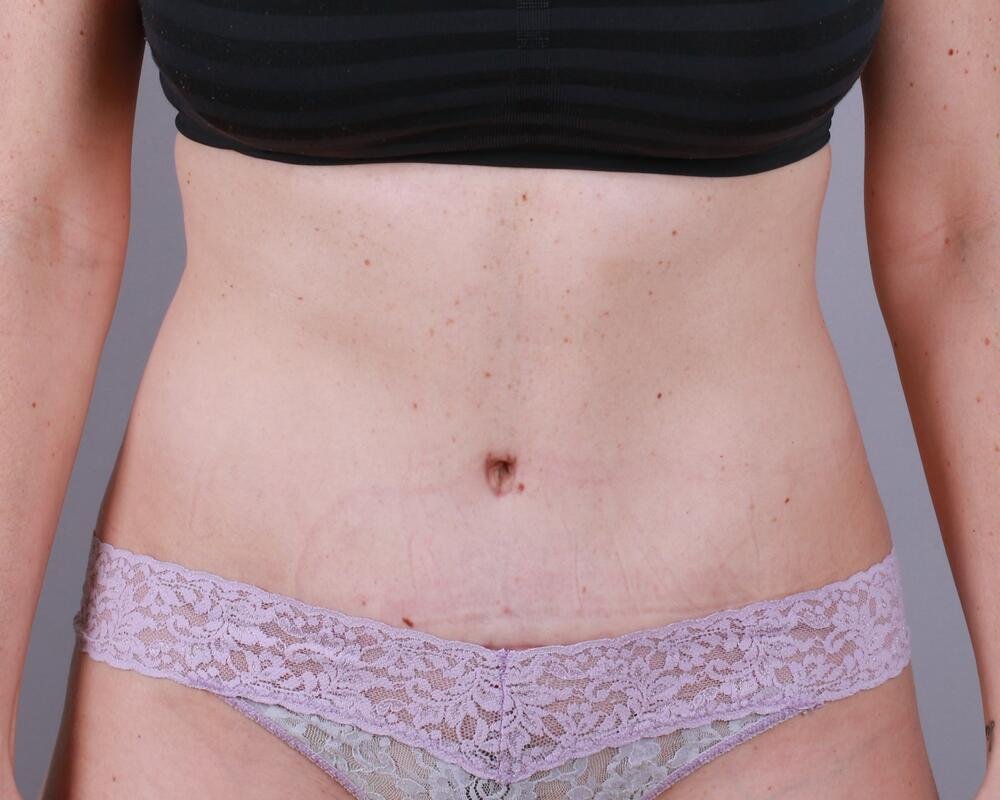 Tummy Tuck Before & After Image