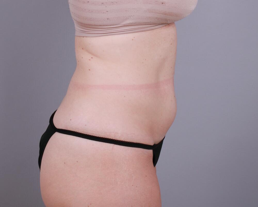 Tummy Tuck Before & After Image