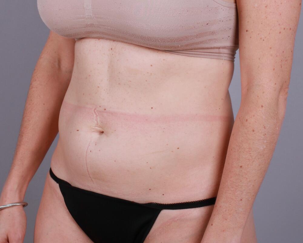 Tummy Tuck Before & After Image