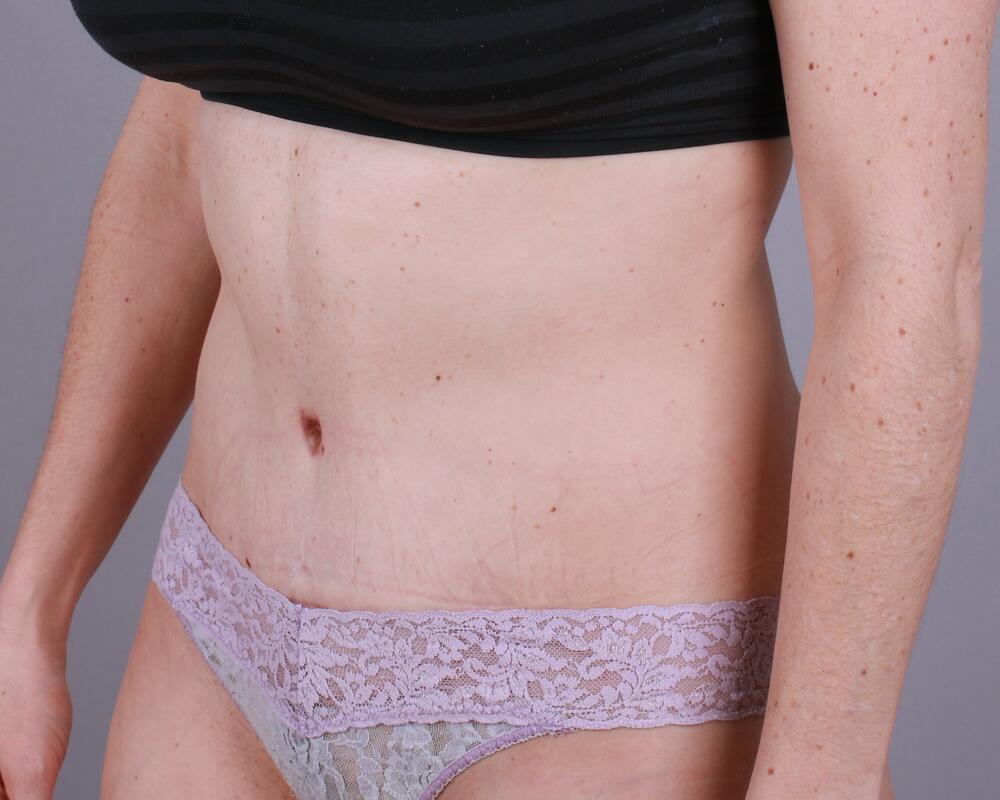 Tummy Tuck Before & After Image